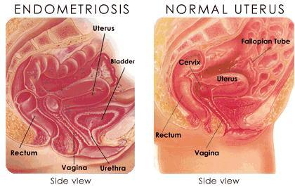 Tratamiento natural de la endometriosis education-endometriosis