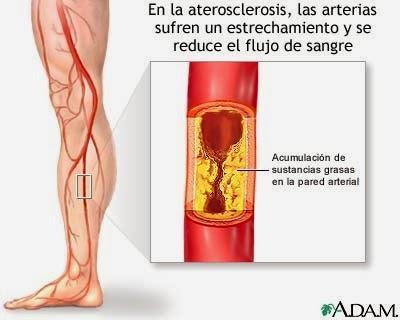 Enfermedades más comunes (Corazón, Vasos Sanguíneos y Sangre) Parte II