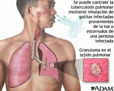 ¿Cuáles son las enfermedades más comunes del Sistema Respiratorio?