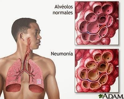 ¿Cuáles son las enfermedades más comunes del Sistema Respiratorio?