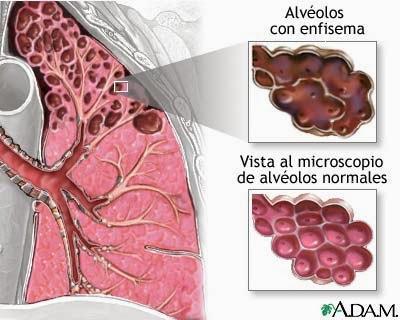 ¿Cuáles son las enfermedades más comunes del Sistema Respiratorio?