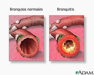 ¿Cuáles son las enfermedades más comunes del Sistema Respiratorio? ¿Cuáles son las enfermedades más comunes del Sistema Respiratorio?