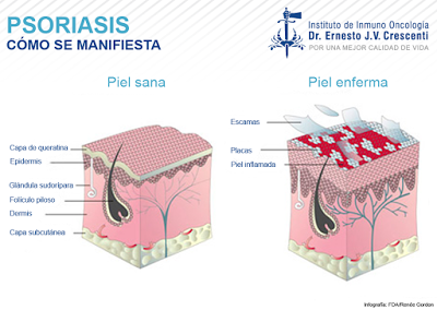 Día Mundial de la Psoriasis (29 de Octubre) Día Mundial de la Psoriasis (29 de Octubre)