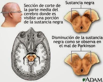 Enfermedades: PARKINSON