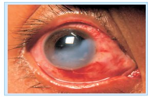 Enfermedades más comunes de los Ojos (Parte II)