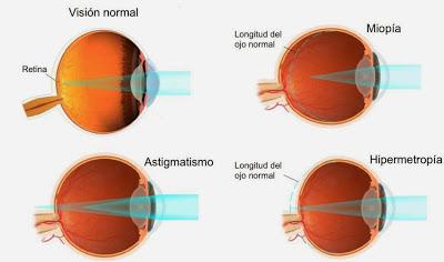 Enfermedades más comunes de los Ojos (Parte II)