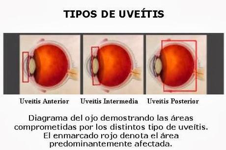Enfermedades más comunes de los Ojos (Parte I)
