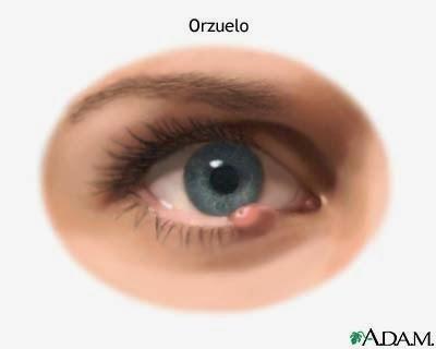 Enfermedades más comunes de los Ojos (Parte I)