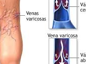 varices