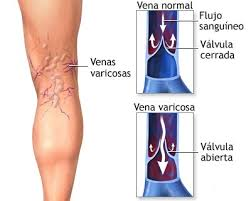 varices