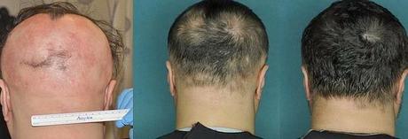 fármaco logra regenerar el cabello perdido en 5 meses