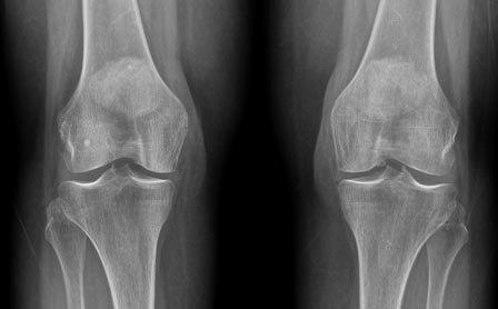 Células madre de hueso y cartílago