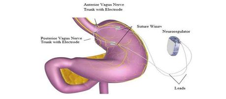 FDA aprueba 1er dispositivo para adelgazar que ataca la vía nerviosa entre el cerebro y el estómago