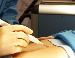 iKnife: bisturí inteligente que detecta tejidos cancerígenos