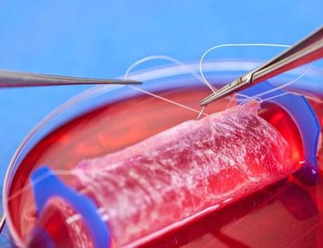 Implantan con éxito vaginas cultivadas en laboratorio