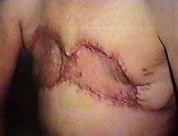 Todo sobre la anestesia para la rinoplastía [2]