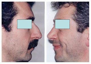 Todo sobre la anestesia para la rinoplastía [2]