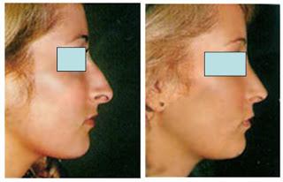 Todo sobre la anestesia para la rinoplastía [2]