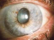 Hipertensión aumenta riesgo glaucoma