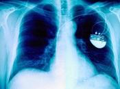 Marcapasos Hecho Colombia