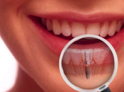 ¿Qué esperar cirugía implantes dentales?