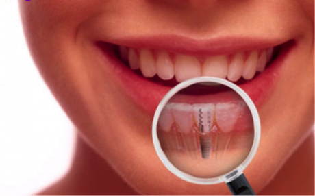Cirugia de implantes dentales