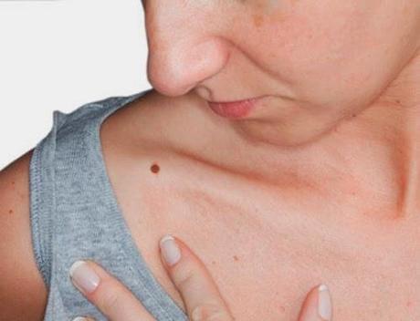 Cómo Prevenir algunos tipos  de cáncer en la piel