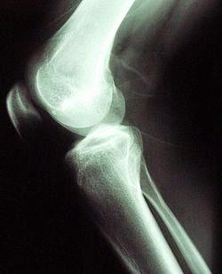 Cirugía de reemplazo de rodilla: ¿Alivia dolor?