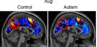 Perder el exceso de peso beneficiaría al cerebro