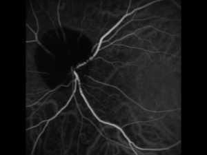 VASCULITIS, COMPLICACIÓN DE LA ARTRITIS REUMATOIDE QUE NO DEBES DEJAR PASAR Vasculitis Artricenter