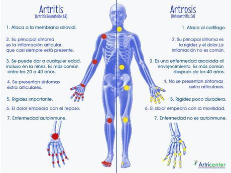 Artrosis y artritis: diferencias, síntomas y prevención