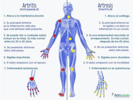 Artrosis y artritis: diferencias, síntomas y prevención