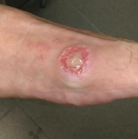 3 Consejos para evitar el Botulismo