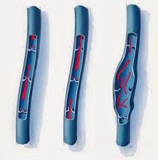 ¿Que causa el Calambre muscular?