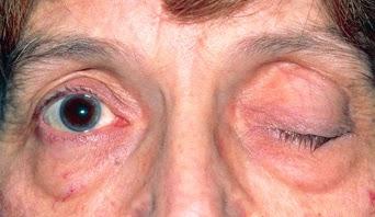 ¿Que es la Miastenia grave?