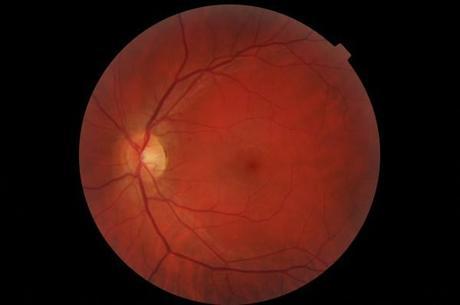 Autoexplorando el interior del ojo con el móvil Mi-retinografia-Octubre-2014-post