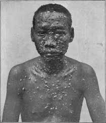 PIAN : ¿Sabes que es?