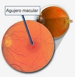 7 Enfermedades de la retina que afectan tu vista