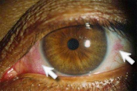 7 Enfermedades de la retina que afectan tu vista