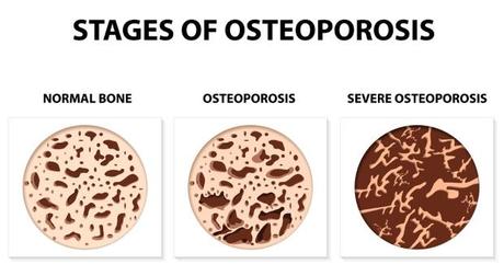 Cómo combatir la osteoporosis y otras enfermedades óseas