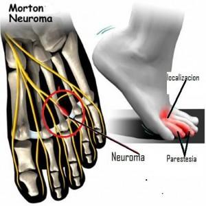 Neuroma de Morton1
