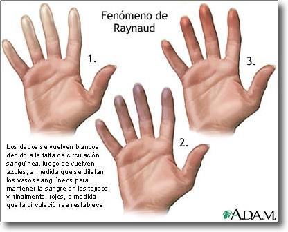 enfermedad de raynaud