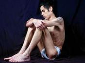 ¿Anorexia hombres?