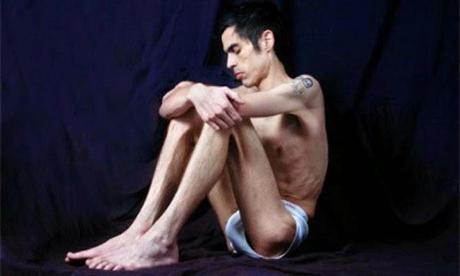 ¿Anorexia en hombres?