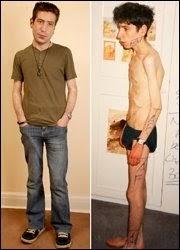 ¿Anorexia en hombres?