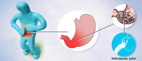 Helicobacter Pylori img_helicobacter-pylori