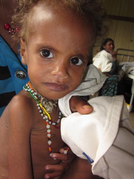 Ruziya el día del ingreso. Iñaki Alegria. Etiopía. Niños. Desnutrición. Marasmo