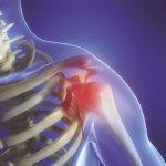 ¿DOLOR DE HOMBRO? PUEDE SER OSTEOARTRITIS hombro artricenter