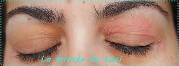 ECZEMA EN EL CONTORNO DE OJOS