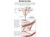 problemas informados usuarias anticonceptivo Essure